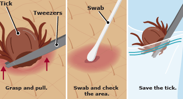 How To Safely Remove a Tick