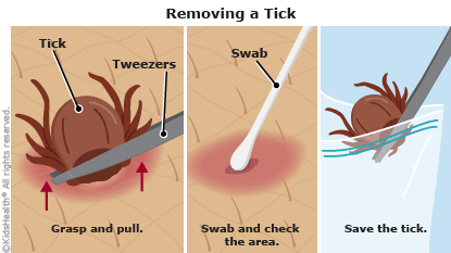 How To Remove a Tick